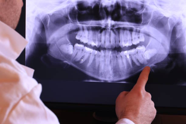 Best Emergency Wisdom Tooth Extraction in North Sarasota, FL